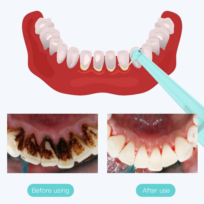 Intelligent High-Frequency Vibration Dental Calculus & Stain Remover(blue) - Image 5