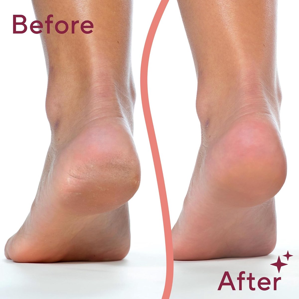 Foot Repair - Rechargeable Electric Callus Remover - Removes Dry Skin - For Smoother Feet - Image 2