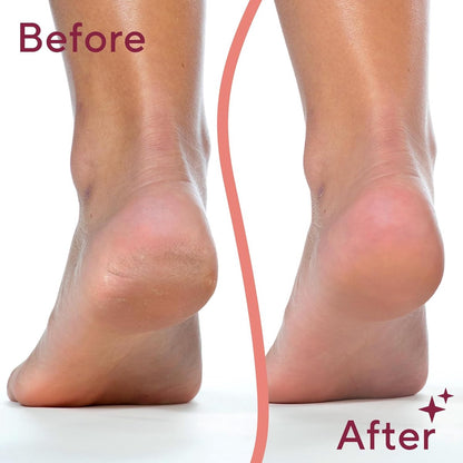 Foot Repair - Rechargeable Electric Callus Remover - Removes Dry Skin - For Smoother Feet - Image 2