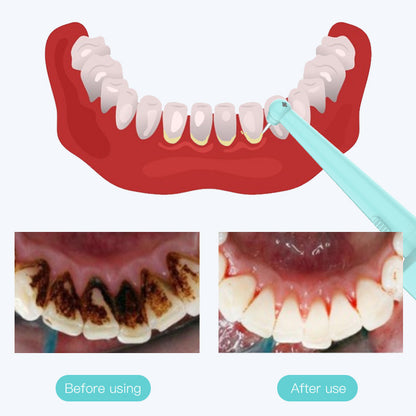 Intelligent High-Frequency Vibration Dental Calculus & Stain Remover(blue) - Image 5