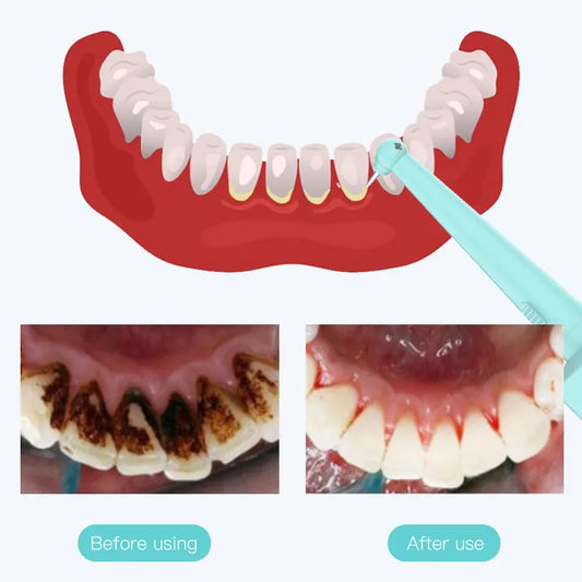 Intelligent High-Frequency Vibration Dental Calculus & Stain Remover(black) - Image 5